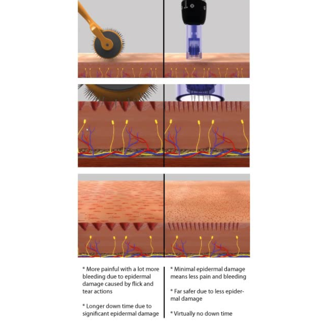Precision Pulse Microneedling™ Pen